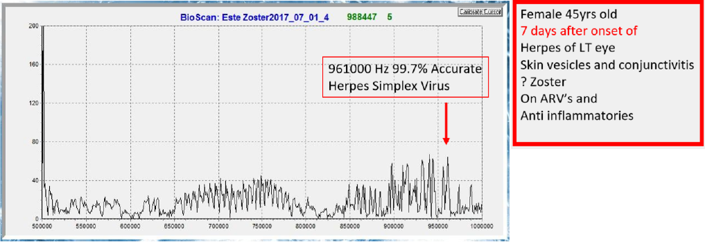 Herpes Simplex Virus